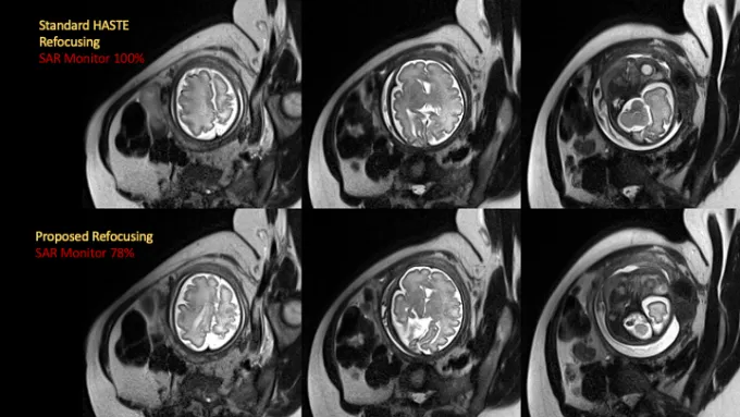 Figure from: Design of Novel RF Pulse for Fetal MRI Refocusing Trains using Rank Factorization (SLfRank) to Reduce SAR and Improve Image Acquisition Efficiency